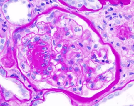 Glomeruloskleróza